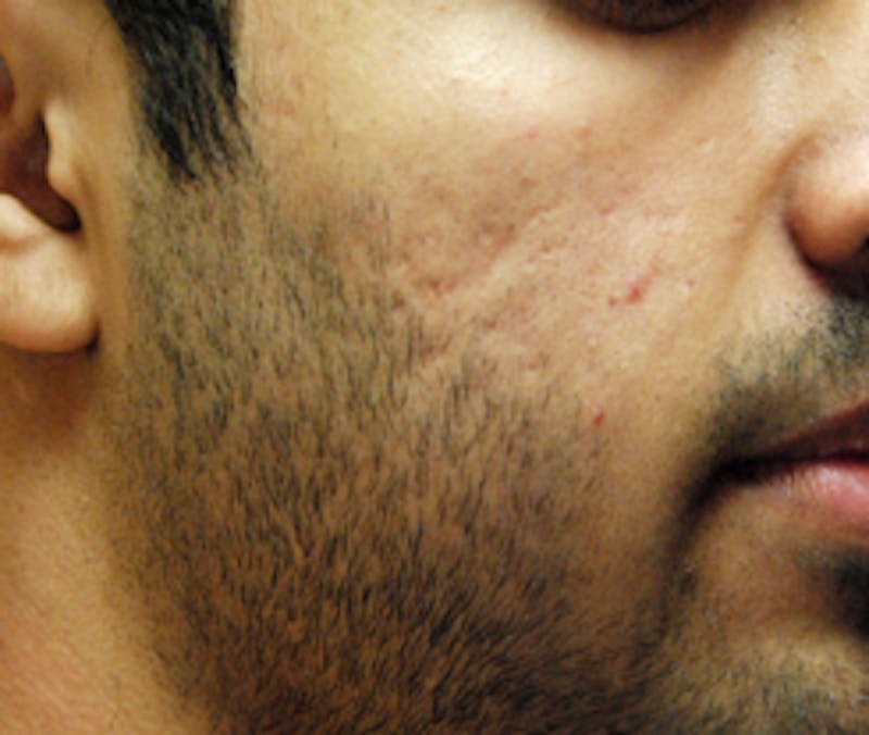 Scar Revision Before & After Gallery - Patient 197778 - Image 5