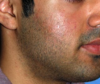 Scar Revision Before & After Gallery - Patient 197778 - Image 6