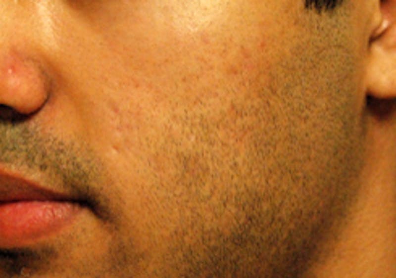 Scar Revision Before & After Gallery - Patient 197778 - Image 7