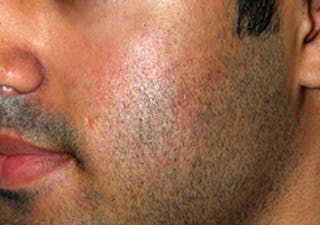 Scar Revision Before & After Gallery - Patient 197778 - Image 8