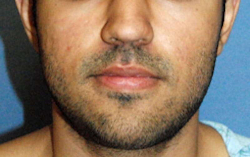 Scar Revision Before & After Gallery - Patient 197778 - Image 1