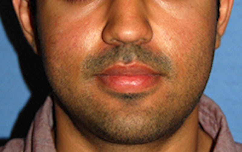 Scar Revision Before & After Gallery - Patient 197778 - Image 2