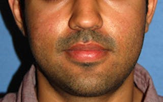 Scar Revision Before & After Gallery - Patient 197778 - Image 2