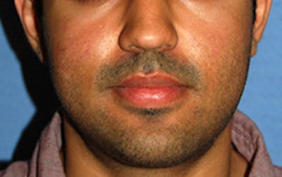 Scar Revision Before & After Gallery - Patient 197778 - Image 2
