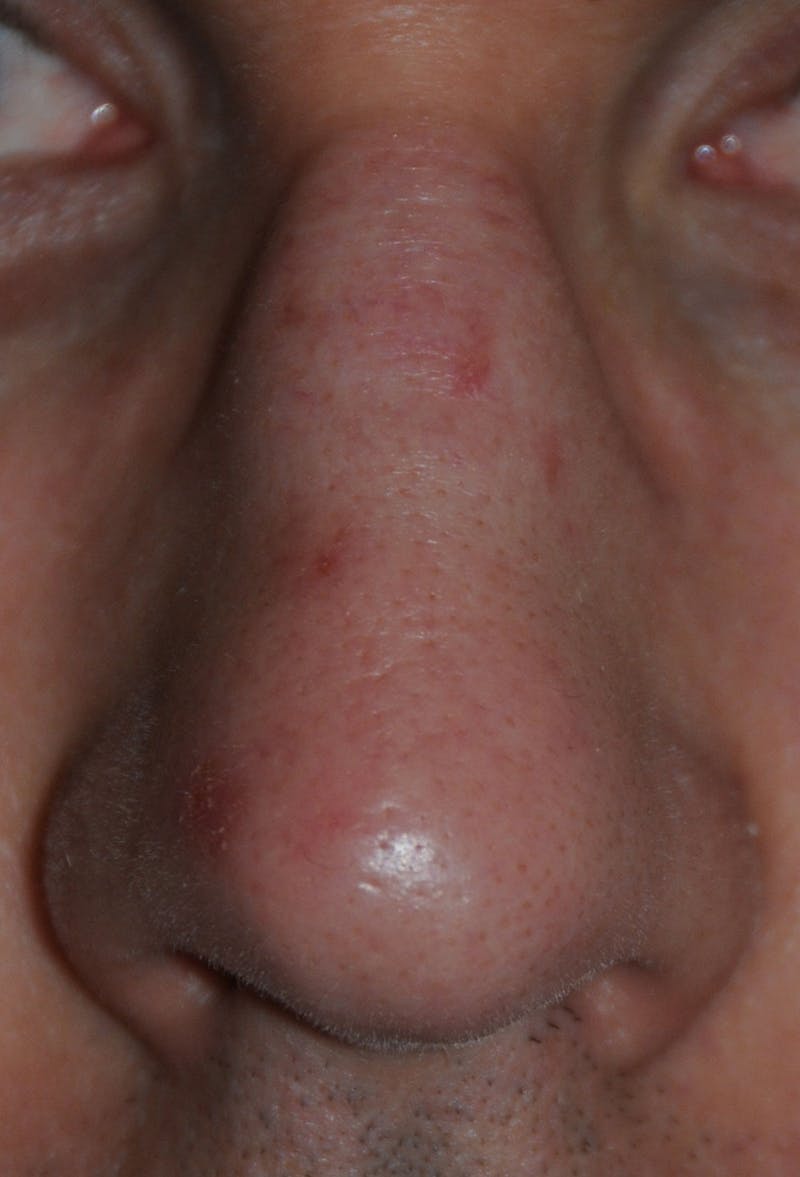 Scar Revision Before & After Gallery - Patient 215519 - Image 1