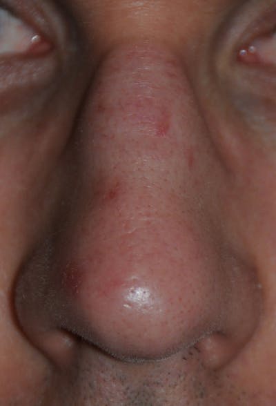 Acne Scar Treatment Before & After Gallery - Patient 200840 - Image 1