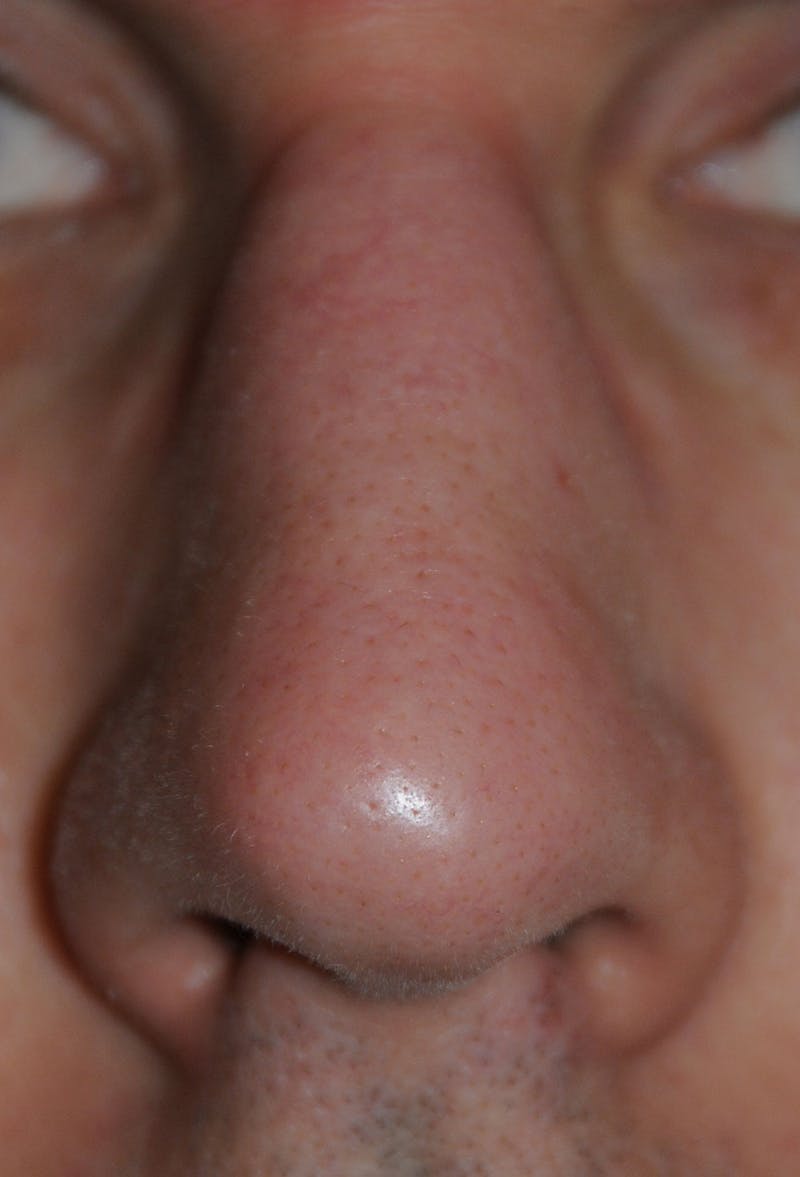 Scar Revision Before & After Gallery - Patient 215519 - Image 2