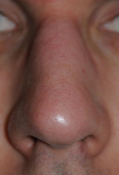 Acne Scar Treatment Before & After Gallery - Patient 200840 - Image 2