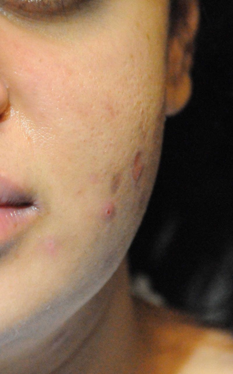 Acne Scar Treatment Before & After Gallery - Patient 427497 - Image 1