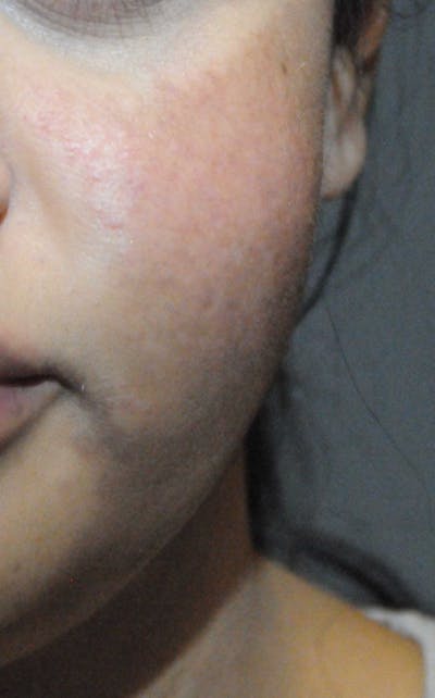 Acne Scar Treatment Before & After Gallery - Patient 427497 - Image 2