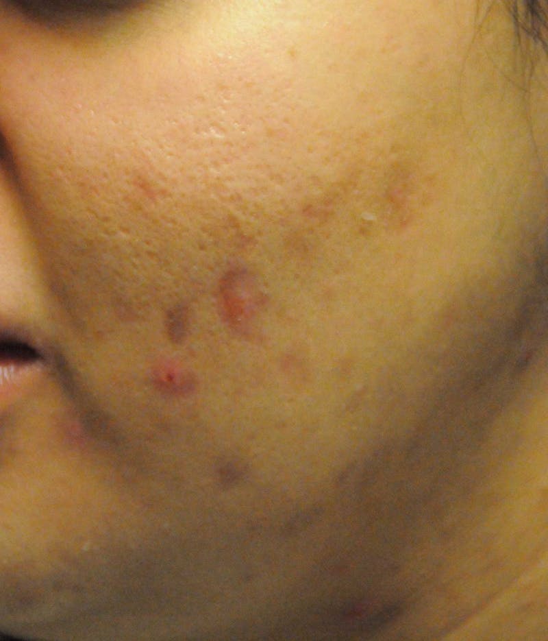 Acne Scar Treatment Before & After Gallery - Patient 427497 - Image 3