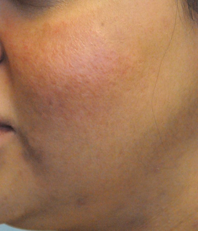 Acne Scar Treatment Before & After Gallery - Patient 427497 - Image 4