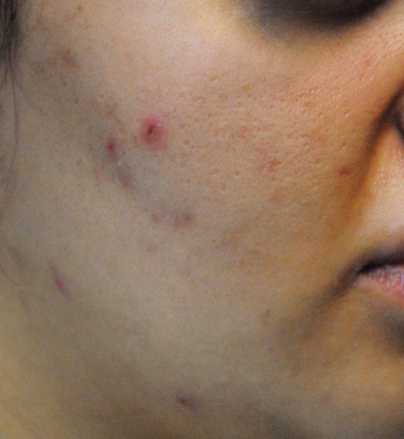 Acne Scar Treatment Before & After Gallery - Patient 427497 - Image 5