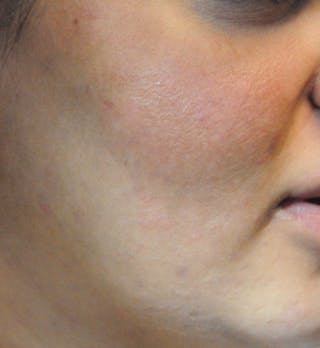 Acne Scar Treatment Before & After Gallery - Patient 427497 - Image 6