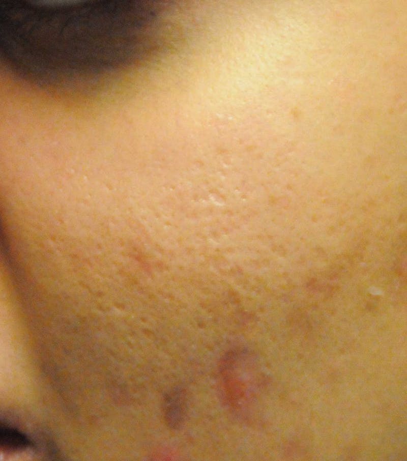 Acne Scar Treatment Before & After Gallery - Patient 427497 - Image 7