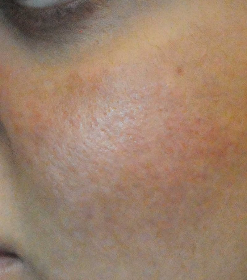 Acne Scar Treatment Before & After Gallery - Patient 427497 - Image 8