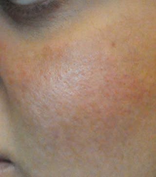 Acne Scar Treatment Before & After Gallery - Patient 427497 - Image 8