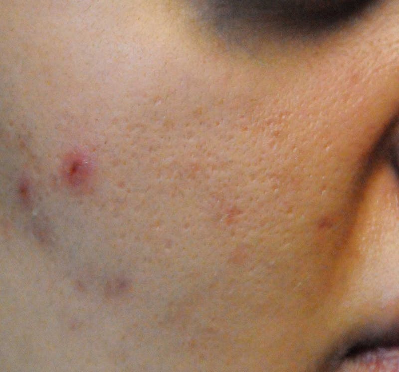 Acne Scar Treatment Before & After Gallery - Patient 427497 - Image 9