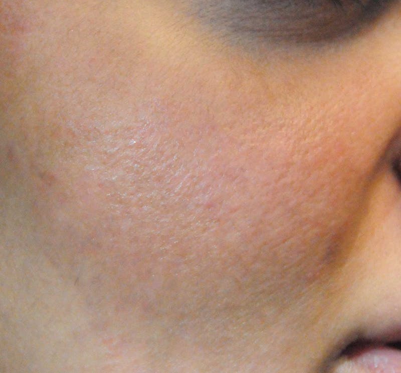 Acne Scar Treatment Before & After Gallery - Patient 427497 - Image 10