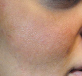 Acne Scar Treatment Before & After Gallery - Patient 427497 - Image 10