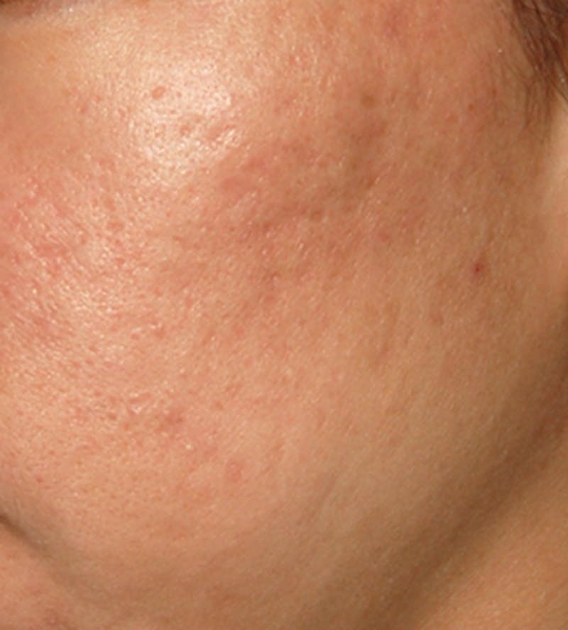 Laser Resurfacing Before & After Gallery - Patient 210414 - Image 1
