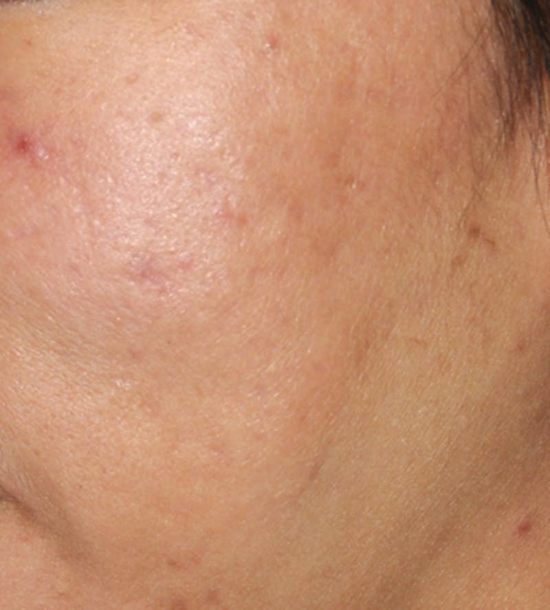Laser Resurfacing Before & After Gallery - Patient 210414 - Image 2