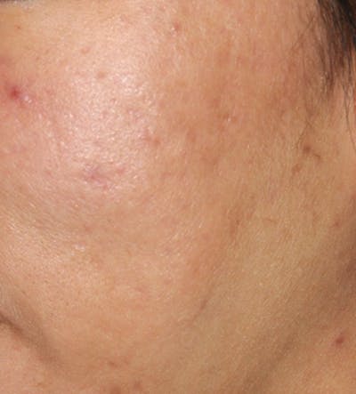 Acne Scar Treatment Before & After Gallery - Patient 397031 - Image 2