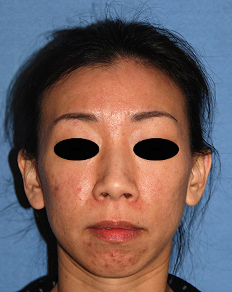 Laser Resurfacing Before & After Gallery - Patient 210414 - Image 3