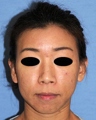 Acne Scar Treatment Before & After Gallery - Patient 397031 - Image 4