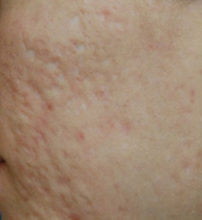 Laser Resurfacing Before & After Gallery - Patient 208490 - Image 1