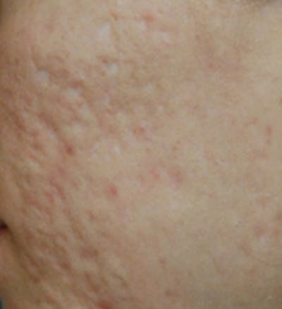 Acne Scar Treatment Before & After Gallery - Patient 365842 - Image 1
