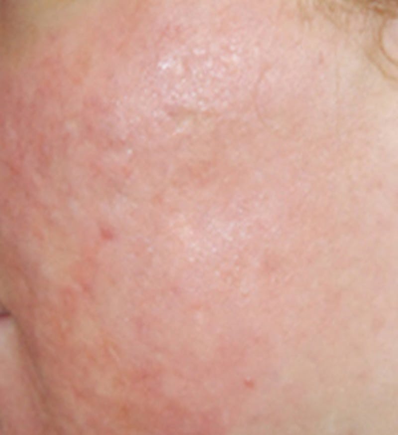 Laser Resurfacing Before & After Gallery - Patient 208490 - Image 2
