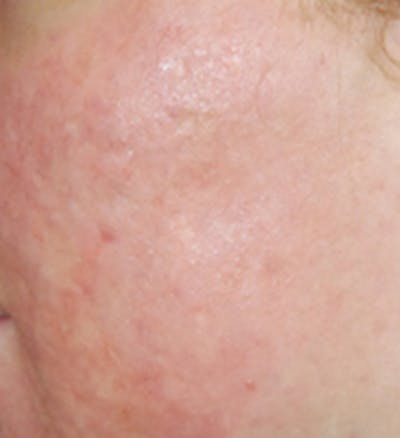 Acne Scar Treatment Before & After Gallery - Patient 365842 - Image 2