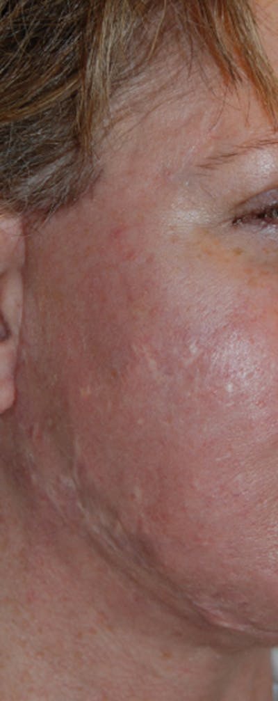 Acne Scar Treatment Before & After Gallery - Patient 133856 - Image 1