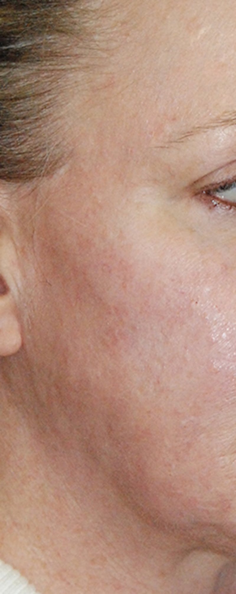 Laser Resurfacing Before & After Gallery - Patient 171473 - Image 2