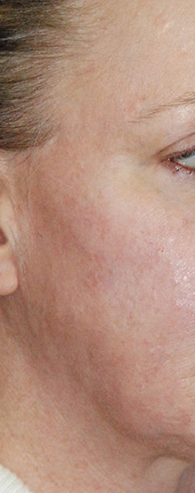 Acne Scar Treatment Before & After Gallery - Patient 133856 - Image 2
