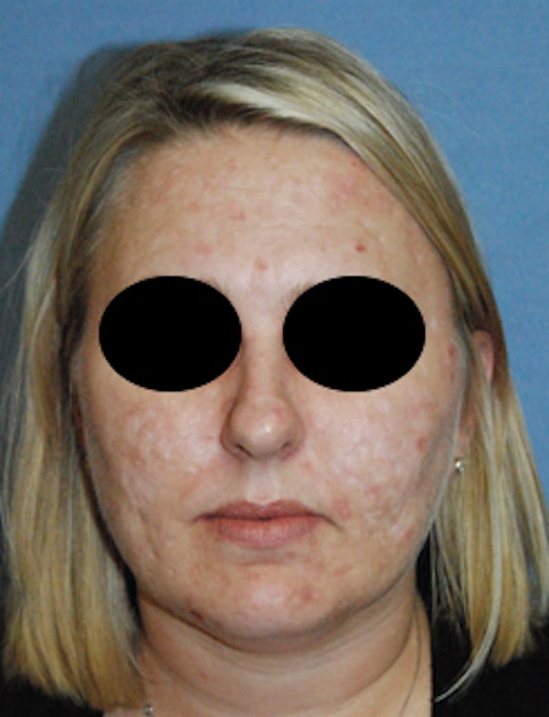 Acne Scar Treatment Before & After Gallery - Patient 161155 - Image 1