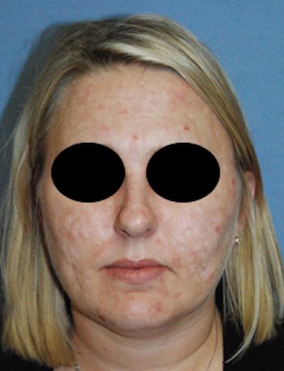 Acne Scar Treatment Before & After Gallery - Patient 161155 - Image 1