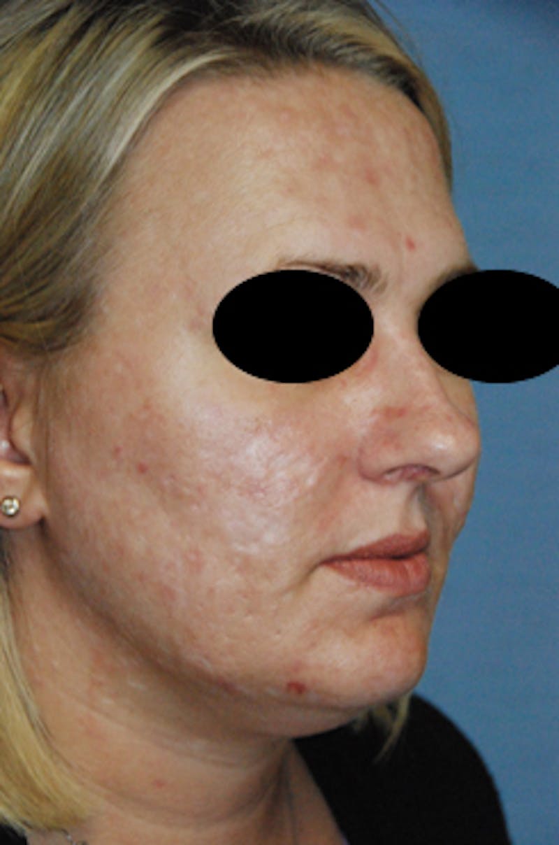 Acne Scar Treatment Before & After Gallery - Patient 161155 - Image 3