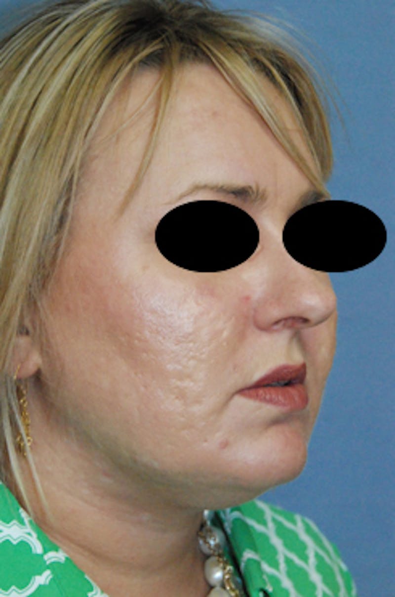Acne Scar Treatment Before & After Gallery - Patient 161155 - Image 4