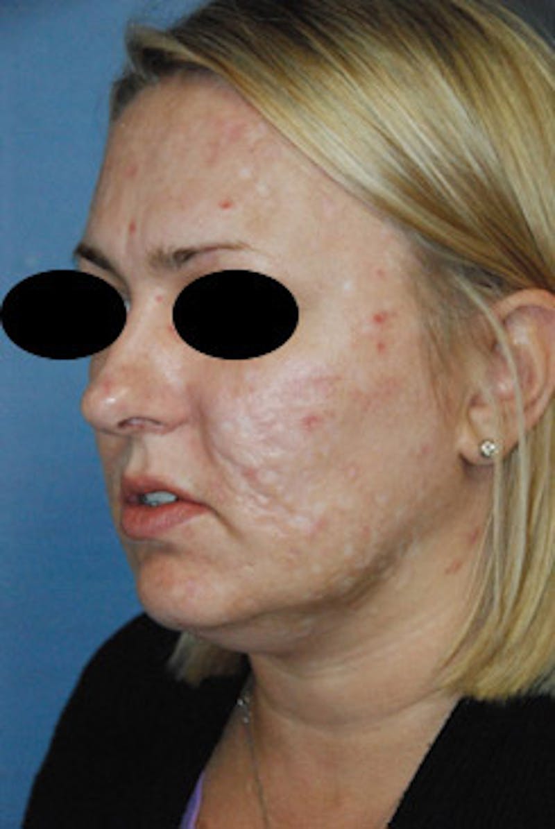 Acne Scar Treatment Before & After Gallery - Patient 161155 - Image 5