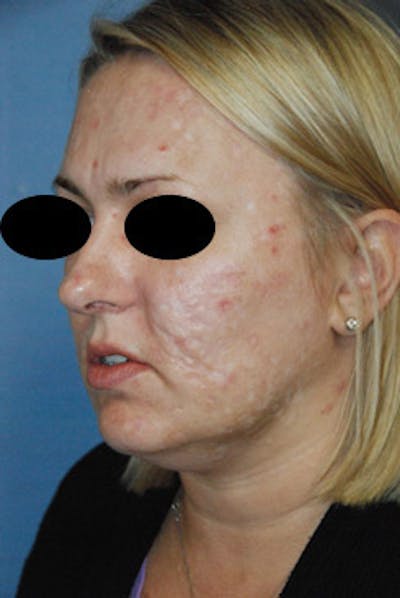 Facial Reconstruction Before & After Gallery - Patient 361682 - Image 1