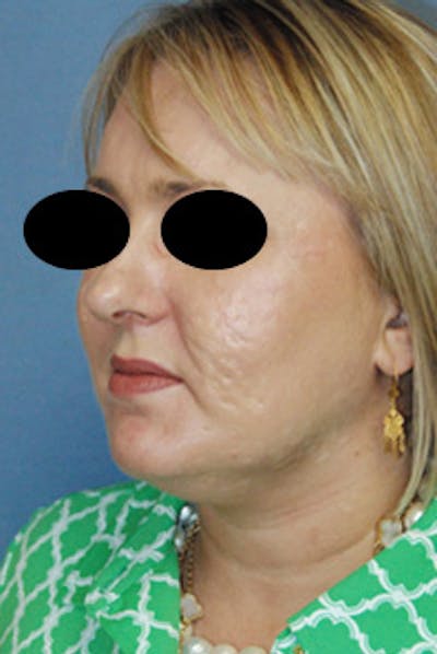 Facial Reconstruction Before & After Gallery - Patient 361682 - Image 2