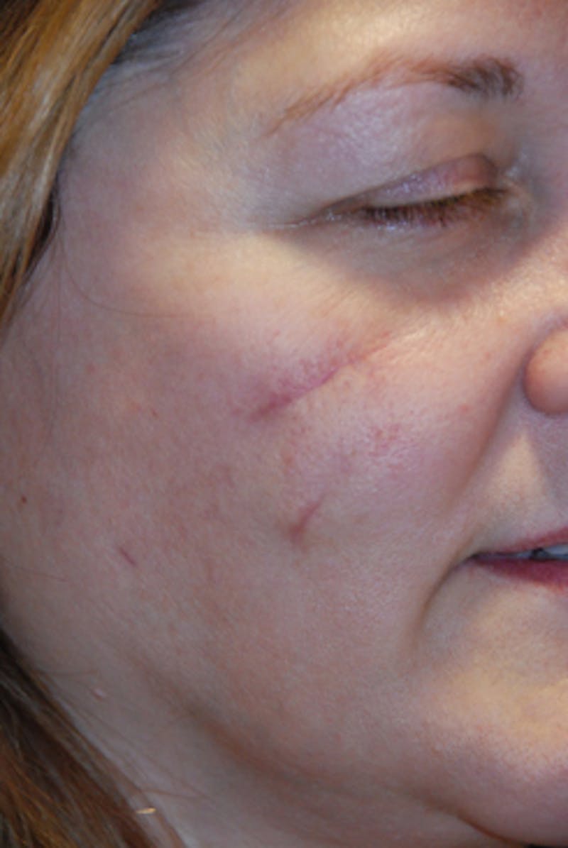 Acne Scar Treatment Before & After Gallery - Patient 505233 - Image 1