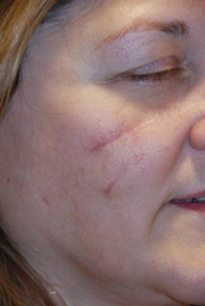 Acne Scar Treatment Before & After Gallery - Patient 505233 - Image 1
