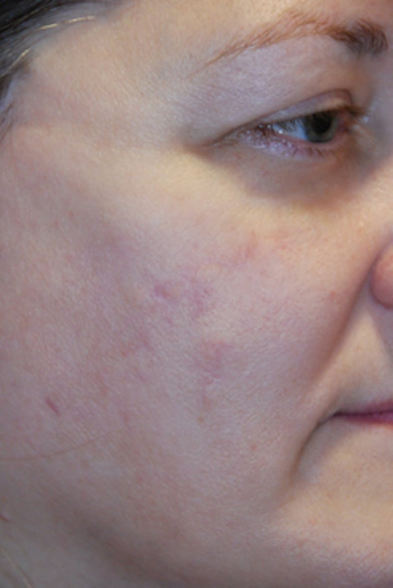 Acne Scar Treatment Before & After Gallery - Patient 505233 - Image 2