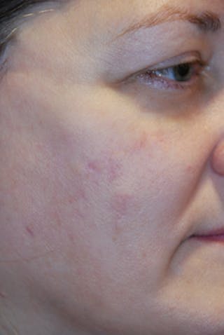 Acne Scar Treatment Before & After Gallery - Patient 505233 - Image 2
