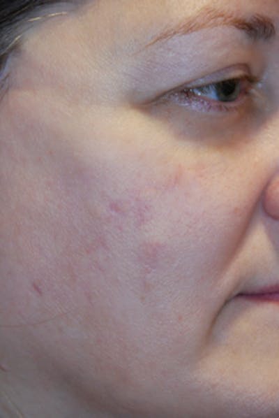 Acne Scar Treatment Before & After Gallery - Patient 505233 - Image 2