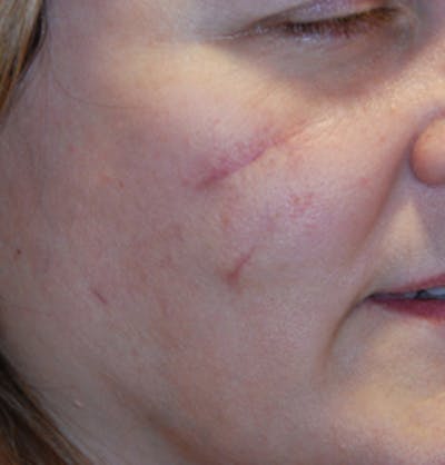 Scar Revision Before & After Gallery - Patient 280972 - Image 1