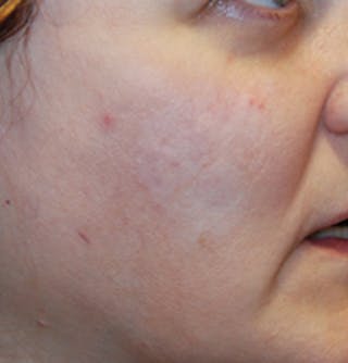 Acne Scar Treatment Before & After Gallery - Patient 505233 - Image 4